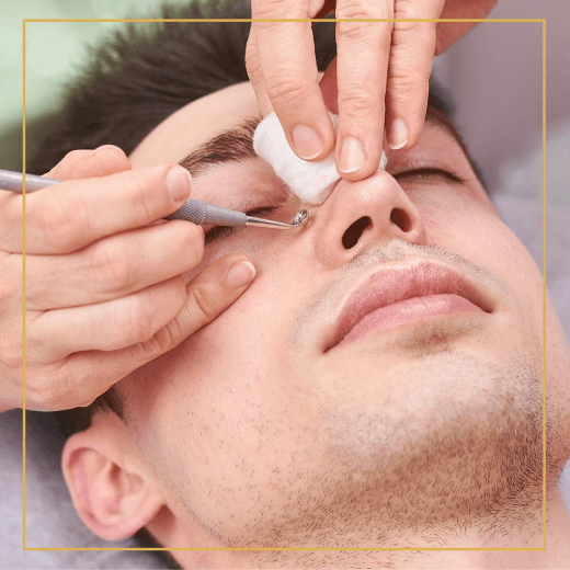 Acne Treatments