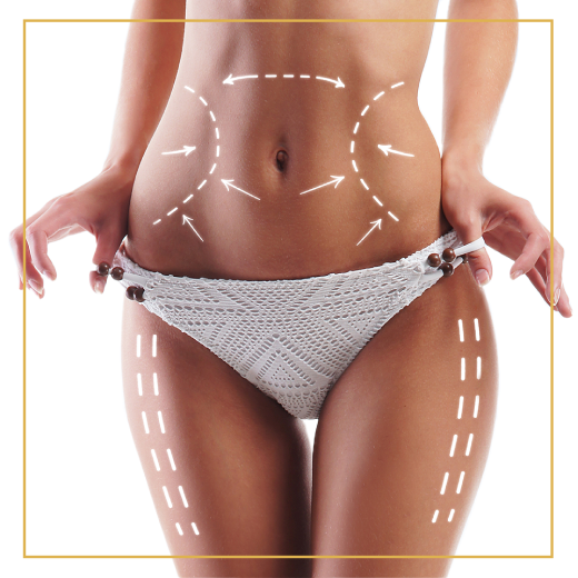 Liposuction