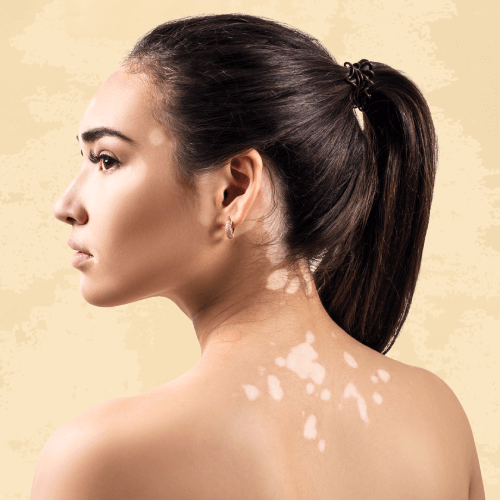 Advanced Vitiligo treatment
